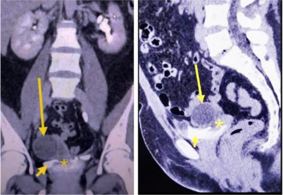 Figure 1. CECT of the abdomen and pelvis showing contrast extravasation from the left side of the posterior wall of urinary bladder (short arrow) into the vaginal vault of tract with intravesical fimbrial herniation (asterisk) and a right ovarian cys