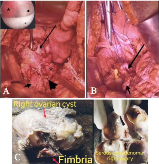 Figure 2. Image showing (A) right ovarian cyst (long arrow) densely adhered near the left vaginal vault apex located near the VVF site (arrow head) with right fimbrial herniation (asterisk) into the bladder (short arrow) through the VVF tract, (B) bl