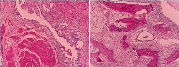 Figure 2. Histologic examination after the second-look surgery consistent with the diagnosis of mature teratoma