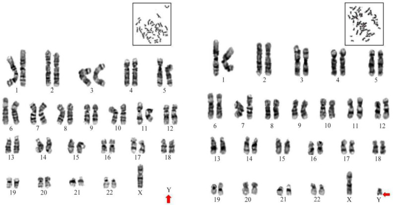 Figure 1. Image of karyotype analysis indicating loss of chromosome Y (left) along with partial deletion of Y chromosome (right)