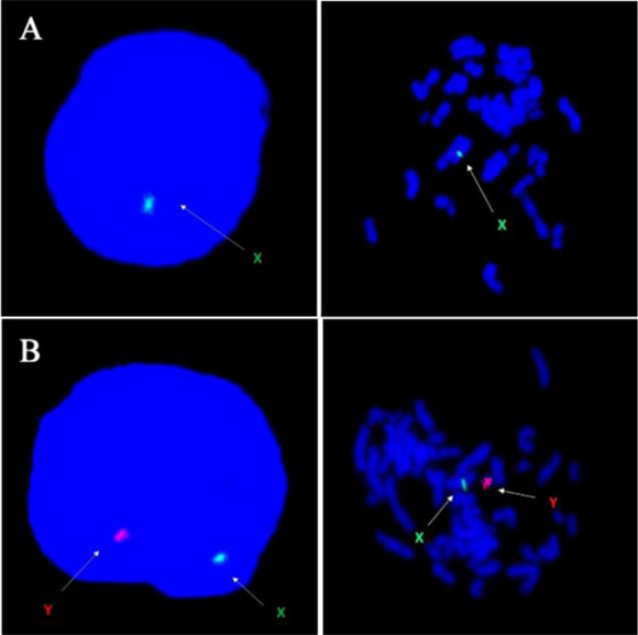 Figure 2. Fluorescence in-situ hybridization: Image A, showing loss of chromosome Y(XO) and image B is showing presence of both sex chromosomes (XY)