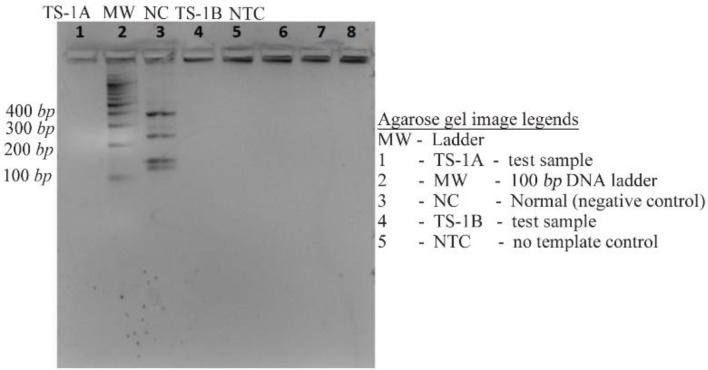 Figure 4. Agarose gel (1.8%) image of Y chromosome microdeletion (AZFc region specific) analysis by multiplex PCR Lane 1: Test sample; absence of four bands indicating deletion of SY254 (400 bp), SY160 (236 bp), SY145 (143 bp), and SY 255 (126 bp) [A