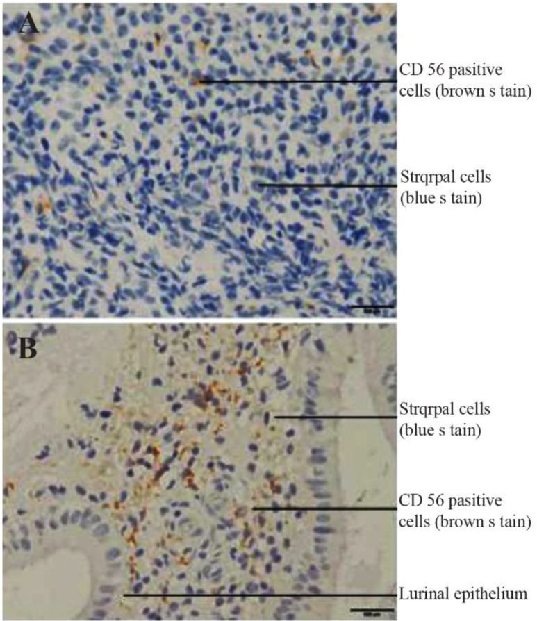 Figure 3. Photomicrograph depicting immunostaining of periimplantation endometrium from fertile control women and women with RIF. CD 56 (brown stain) in normal endometrium (A) CD 56 (brown stain) in endometrium from RIF woman (B). IHC (200X)