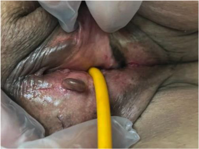 Figure 2 Vulvar endometriosis lesions
