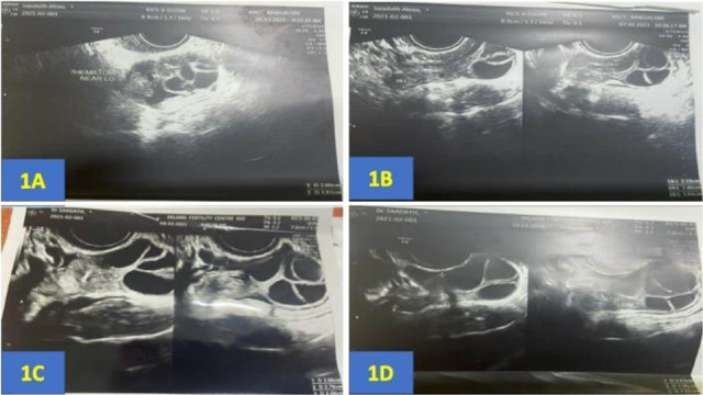 Figure 1 Left periovarian hematoma during controlled ovarian stimulation. 1A) Day 7 of stimulation-Left periovarian hematoma measuring 2.0×1.81×1.55 cm. 1B) Day 9 of stimulation-Left periovarian hematoma measuring 2.3×2.4× 1.9 cm. 1C) Day 10 of stimu