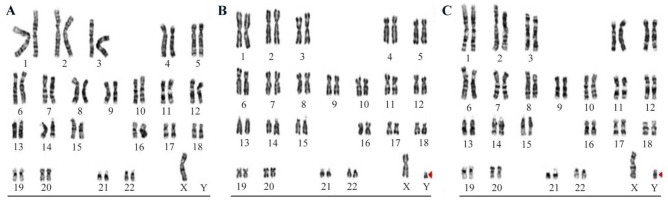 Figure 1 Male karyotype analysis showing the distribution of cell lines observed in a total of 50 cells. Cell line A exhibits 45,X in 44 cells, cell line B shows 46,XY in 5 cells, and cell line C displays 46,X,idic(Yp) in 1 cell