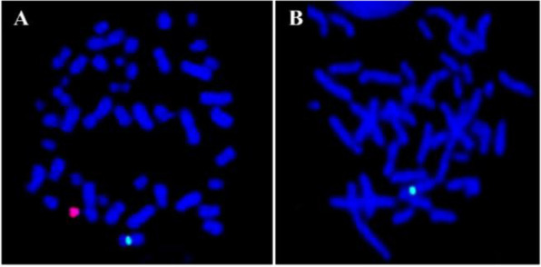 Figure 2 A) Metaphase showing one green signal for X chromosome and one red signal for Y chromosome, B) Metaphase showing one green signal for chromosome X