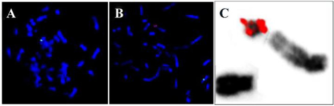 Figure 3 LSI SRY(red)/CEPX(green); A) 45,X cell line with only one green signal for X chromosome; B) 46,X,idic(Yp) cell line with one green signal for X chromosome and two red signals for SRY on the abnormal Y chromosome; C) inverted DAPI image showi