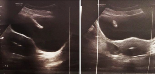 Figure 1. Ultrasound image showing IUD in uterus and bladder