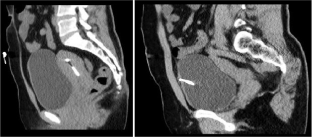 Figure 2. CT scan showing IUD in the bladder and uterus