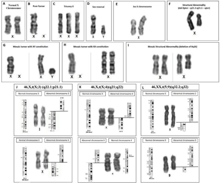Figure 1. Partial karyotype images of the chromosome abnormalities: (A) normal female, (B) monosomy X, (C) trisomy X, (D) male karyotype: XY, (E) isochromosome of long arm of X: 46,X,i(Xq), (F) 46,X,del(X)(pter→p21.1:q21.1→qter), (G) mosaic Turner sy