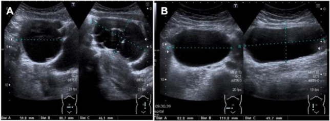 Figure 1 Transvaginal ultrasound images from the first visit demonstrating an 8.1×6×4.6 cm complex cystic structure in the midline of the pelvis (A) and a second cyst measuring 12×8.3×5 cm to the right of the midline (B)