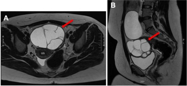 Figure 2 T2-weighted magnetic resonance imaging demonstrating a transverse view (A) and a sagittal view (B) of a multiloculated left ovarian cyst measuring 7.3×8×8 cm with thin septations distributed throughout