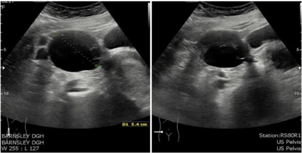 Figure 3 Transvaginal ultrasound images from second visit demonstrating a 5.4 cm right ovarian cyst containing loculations and some solid areas