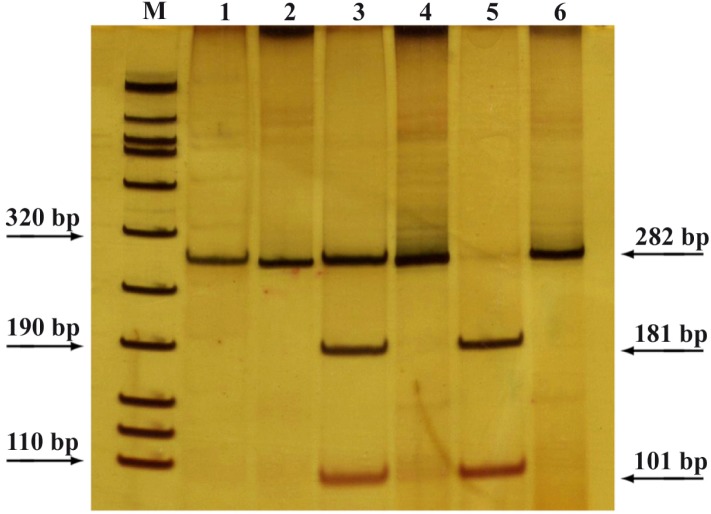 Figure 1 Restriction digestion of PCR products demonstrating the patterns of digestion in different genotypes of VEGF +405 G>C Polymorphism. M: Marker VIII (Roche), 1: Homozygote (variant), 3: Heterozygote (variant and wild type), 5: Homozygote (w