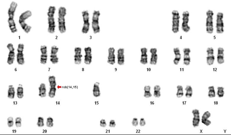Figure 1 Karyotype of the female with 45, XX, rob (14;15) (q10;q10) chromosomal constitution