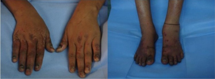 Figure 1 Sharp demarcation of normal from abnormal areas by day 5