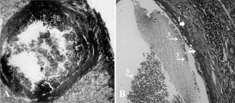 Figure 1 Cross-section of the ovary 63 days after bilateral uterine artery ligation, A: a low magnification view of atretic follicles (301–400 µM) with dissociated granulosa cells; B: a high magnification view of atretic follicles (301–400 µM) with d