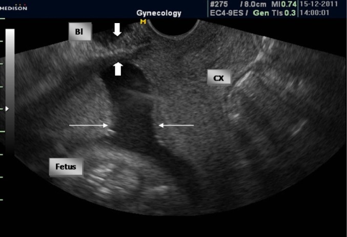 Figure 1 Transvaginal ultrasound examination in the 24th week of gestation demonstrated a 17 mm fenestration within the uterine scar (Large arrow). Thinning of the myometrium over the cesarean scar defect is seen behind the bladder (Small arrow)