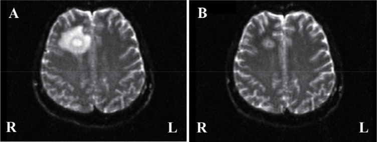 Figure 2 Magnetic resonance images of the brain abscess. Both images are taken by diffusion weighed imaging. A: Axial image at 22ne week of pregnancy shows the large right frontal abscess with severe edema. B: Axial image at 28th week of pregnancy sh