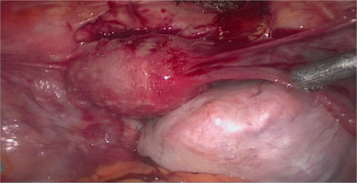 Figure 1 Primary laparoscopy feature of the tumor in a 24 year old patient, December 2012, Rasoul-e-Akram hospital, Tehran, Iran