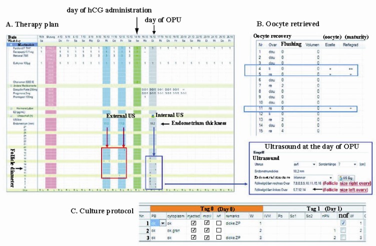 Figure 2 Stimulation, US, oocyte pick-up (OPU) and culture protocol of the patient. The external US measurements are boxed in red, internal US performed with Voluson I ultrasound system plus SONOAVC® is boxed in blue. +/++ represents the grade of ooc