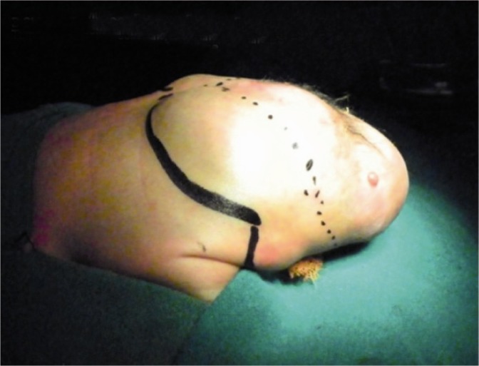 Figure 1 Showing lateral view of the baby with Type II Sacrococcygeal teratoma in Prone Jack Knife position. Tumor is marked with solid line and the incision with dotted line