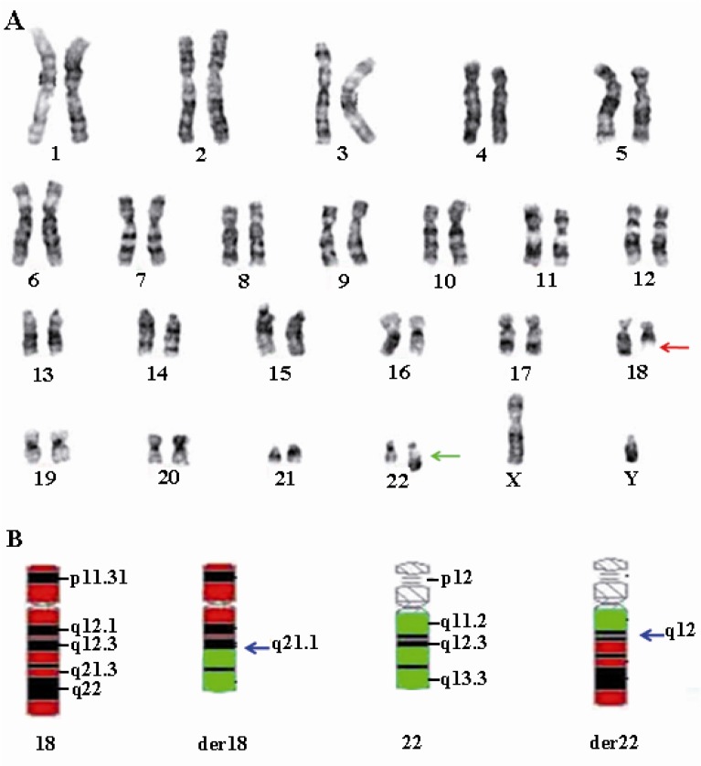 Figure 1 The chromosomes involved in the translocation t(18;22)(q21.1;q12) of the illustrated case. A. The GTG banded karyogram showing the translocation breakpoint regions. B. The partial ideogram showing normal chromosome 18 in red and normal 22 in