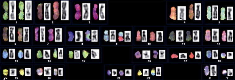 Figure 2 SKY on the lymphocyte metaphase showing the representative karyotypes illustrating the display colours on the left and the classification colours on the right. In the center, there are the DAPI band images