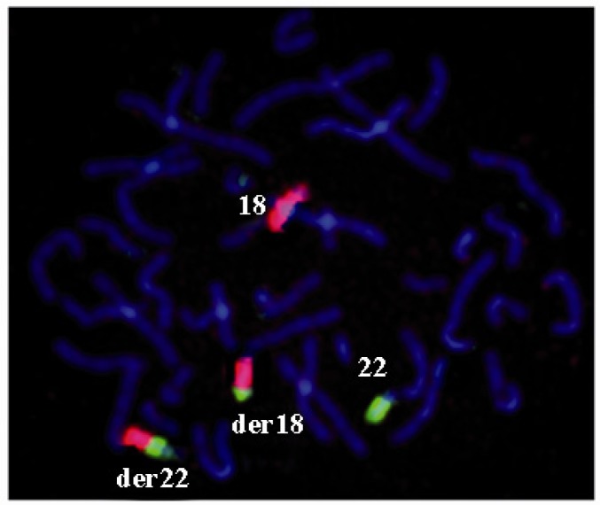 Figure 3 WCP FISH on the metaphase spreads of the proband. The normal chromosome 18 is in red and the normal 22 in green. Derivative 18 and derivative 22 are shown both in red and green