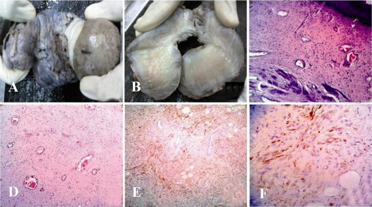 Figure 1 A: Excised polypoidal growth; B: Cut surface was solid, grey brown without any areas of hemorrhage or necrosis; C: Section showing unremarkable stratified squamous epithelium and tumour comprised of spindle and stellate shaped cells with man
