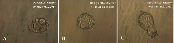 Figure 1 Images of high grade embryos, A: Day 3-8-cell embryo; B: Day 5-blastocyst; C: Day 5-hatching blastocyst