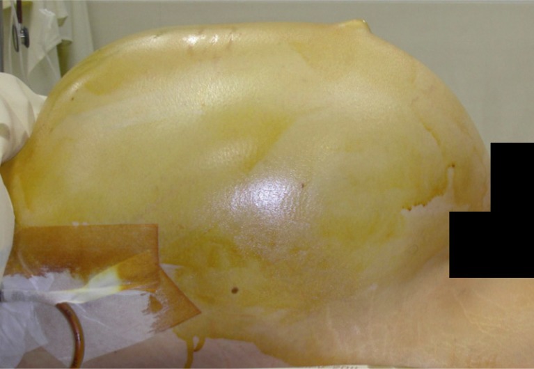 Figure 1 Preoperative appearance of the abdominal distension