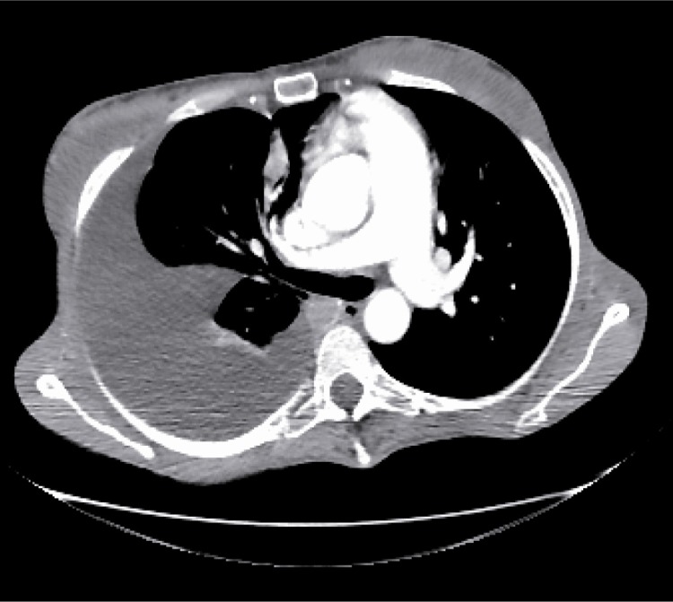Figure 3 Thoracic axial CT-scan showing a right pleural effusion