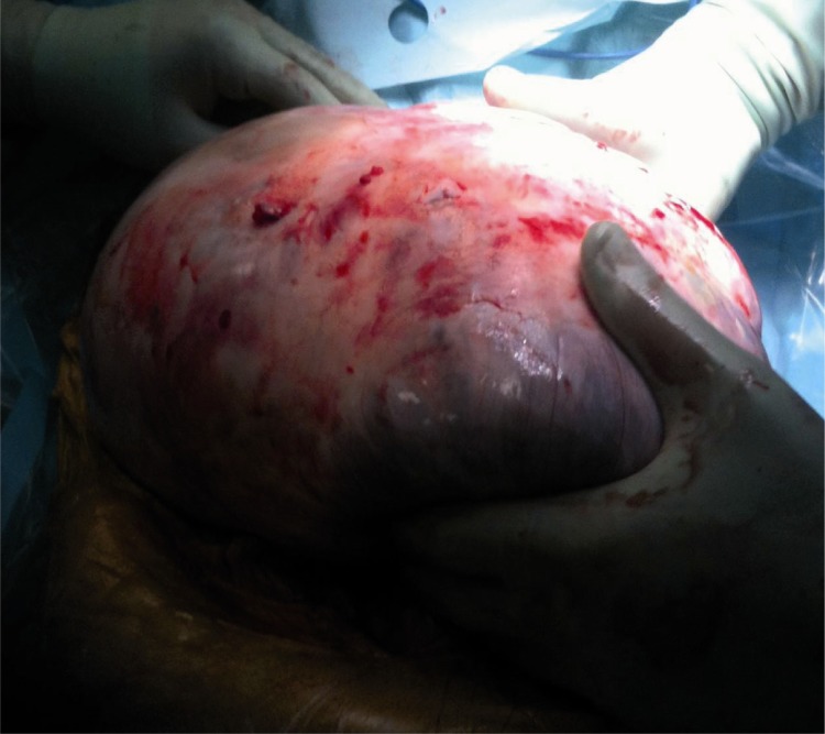 Figure 5 Extraction of the abdominopelvic mass