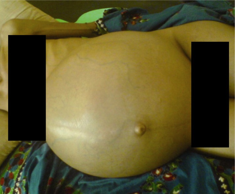 Figure 1 The patient's abdomen at presentation