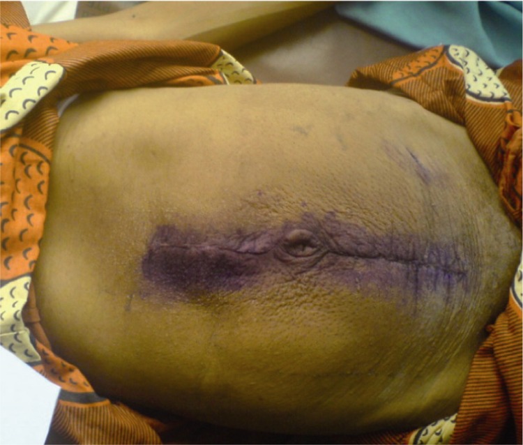 Figure 3 The abdominal wall after removal of skin stitches on the 7th post operative day