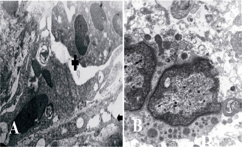 Figure 6 Ultrastructural micrograph of seminiferous tubule in group of 25 μM/kg: myoepithelium (Arrow), necrotic spermatogonia (+), B: necrosis of spermatid. A: magnification 4400, B: magnification 7000