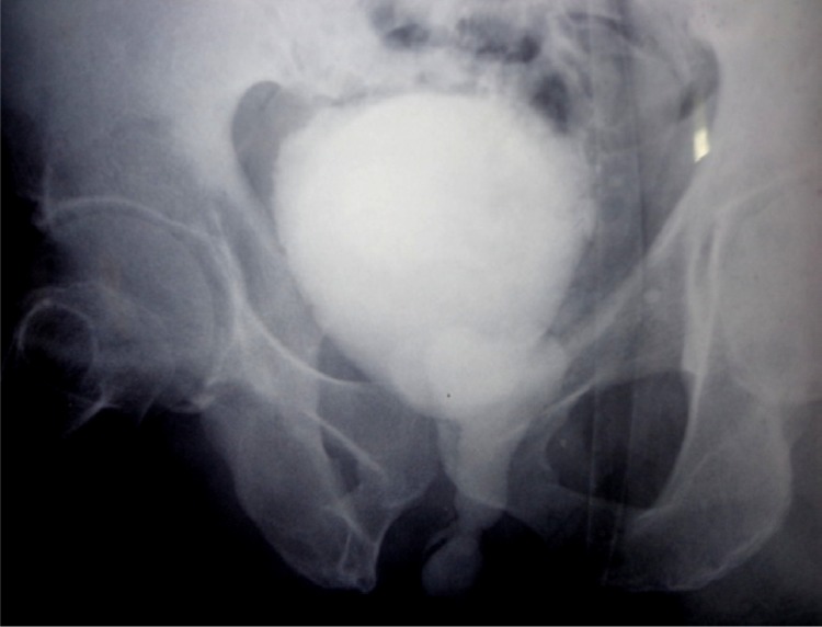 Figure 1 Micturating cystourethrogram of the patient showing dilated posterior urethra