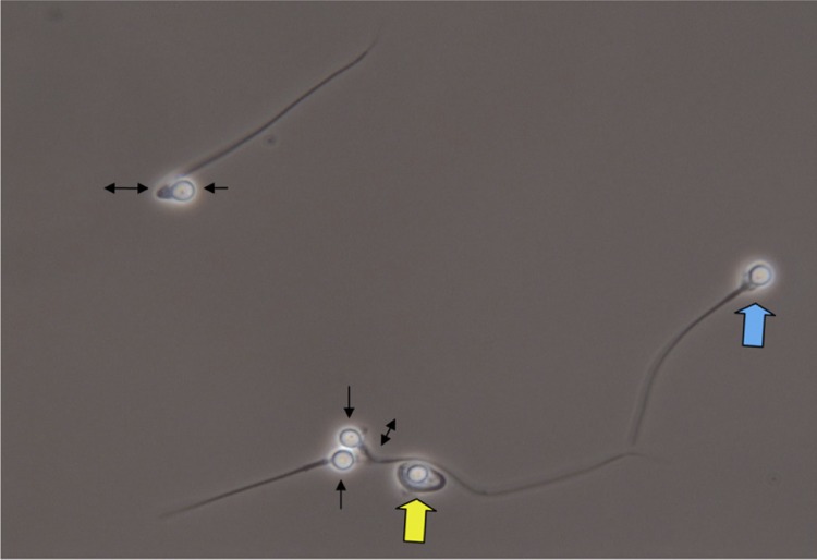 Figure 1 Photomicrographs of the sample with phase contrast microscopy, in which spermatozoa with a round head (arrow), wide (blue arrow) and broken neck (double arrow) are observed. Also, the picture depicts the spermatozoa with dag defect (yellow a