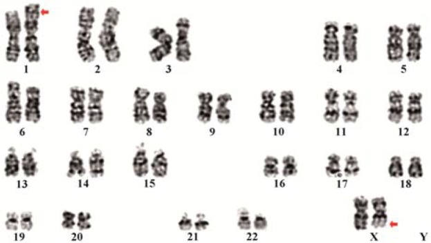 Figure 1. Karyotype showing 46, X, t(X;1)(q21, p32) chromosome constitution in a female with primary amenorrhea