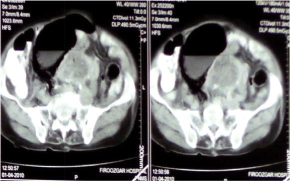 Figure 1. Large mass was shown in pelvic CT scan