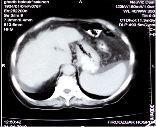 Figure 2. Cirrhosis was revealed by abdominal CT scan