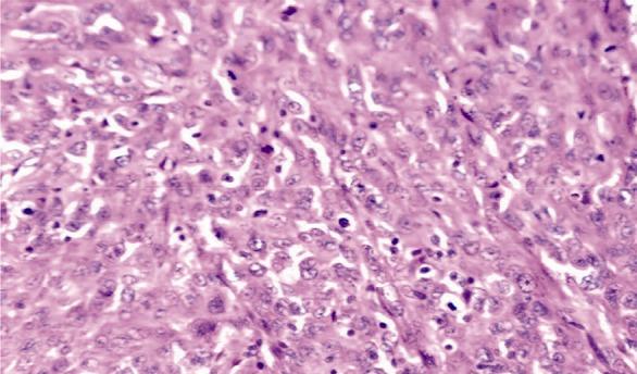Figure 3. Pathology: invasion to myometrium