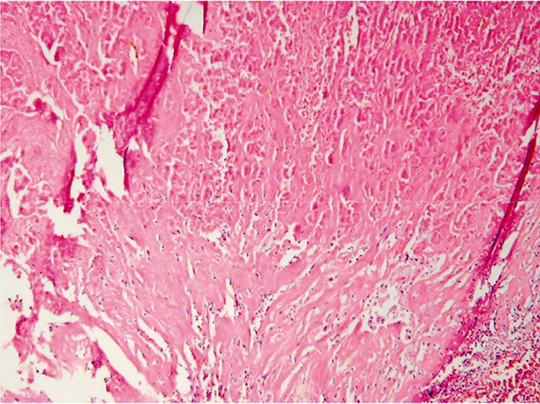 Figure 4. Pathology: invasion to the bladder