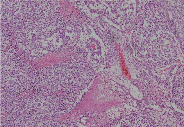 Figure 1. Pathology report, embryonal carcinoma component of the ovarian germ cell tumor