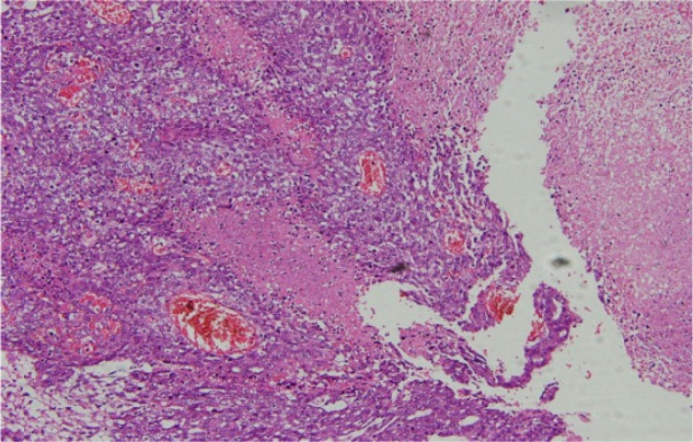 Figure 2. Pathology report, yolk sac tumor component of the ovarian germ cell tumor