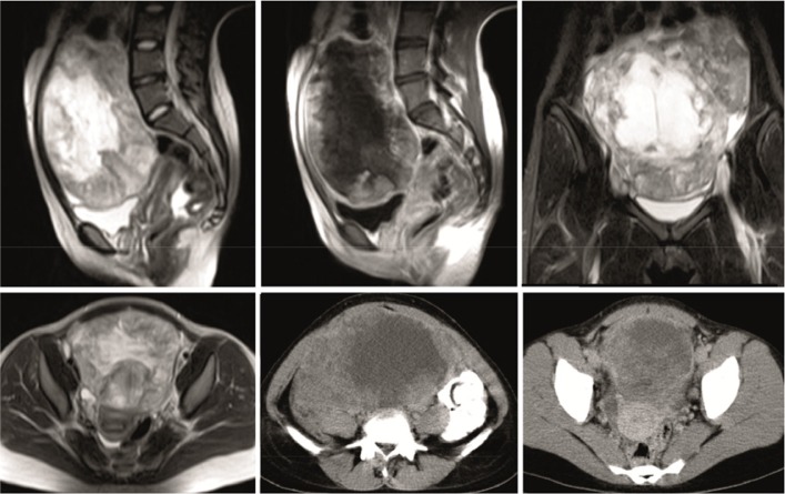 Figure 3. CT and MR images show a huge pelvic mass, just anterior to the uterus, with upward extension to the abdomen. The mass is solid and enhancing at periphery, and centrally necrotic zone. Uterus is obviously separated from the mass on sagittal 