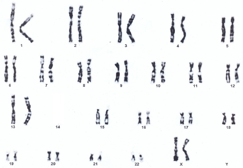 Figure 2. Cytogenetic analysis of female proband
