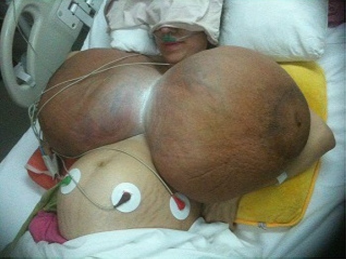 Figure 1. Patients breasts before the surgery